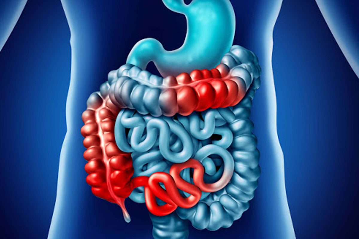 GHHC-inflamatoria_intestinal-1200x800.jpg